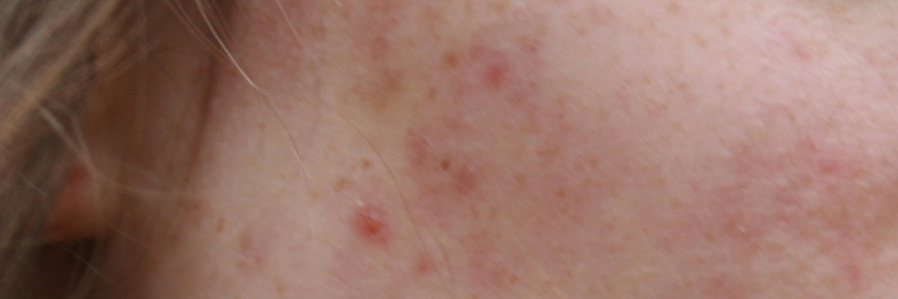 Is Tamanu Oil Good for Acne Scars?