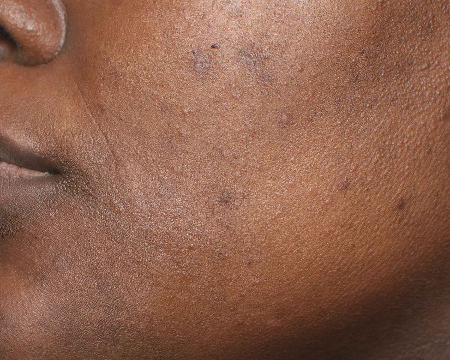 Get rid of dark spots and hyperpigmentation
