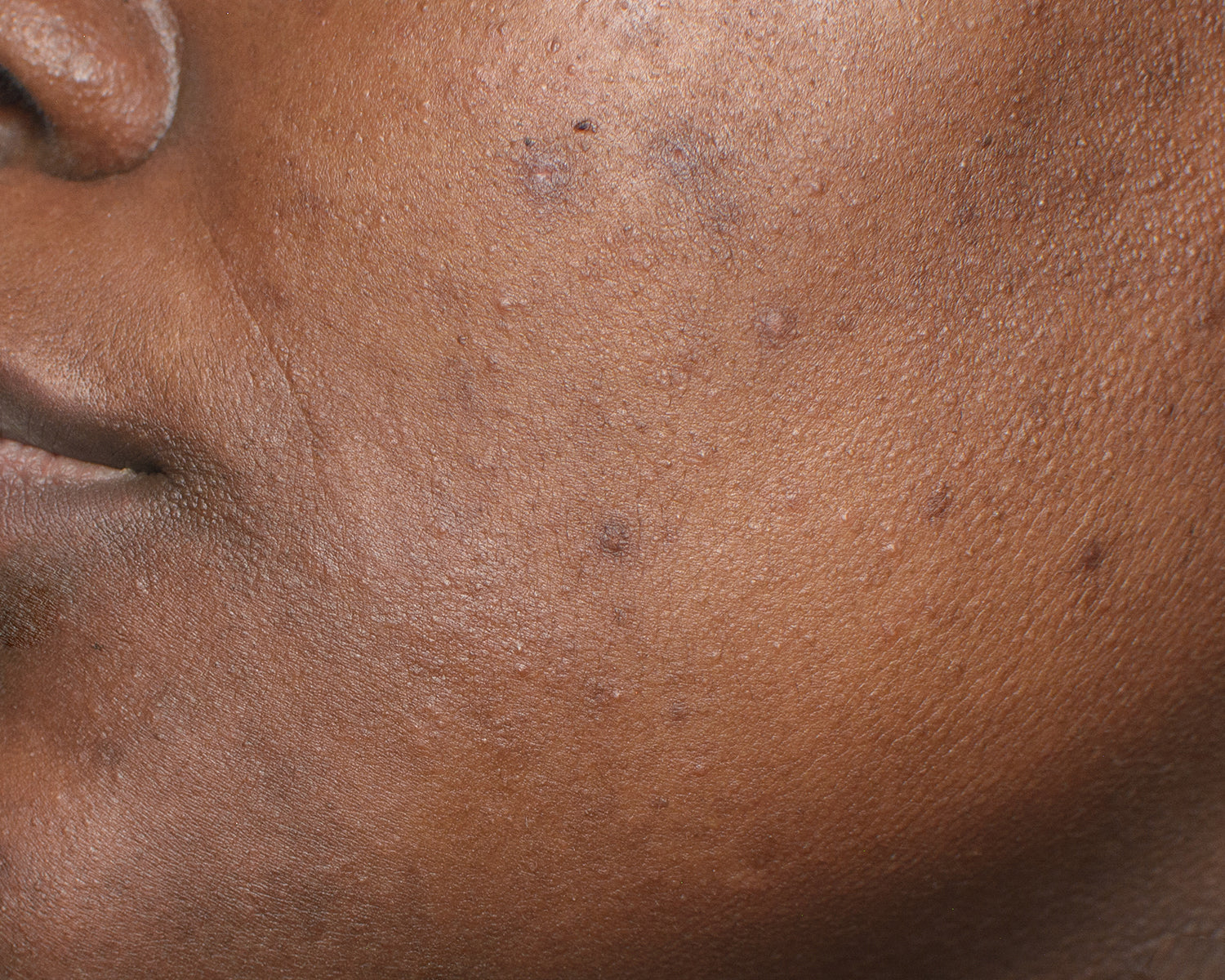 Get rid of dark spots and hyperpigmentation