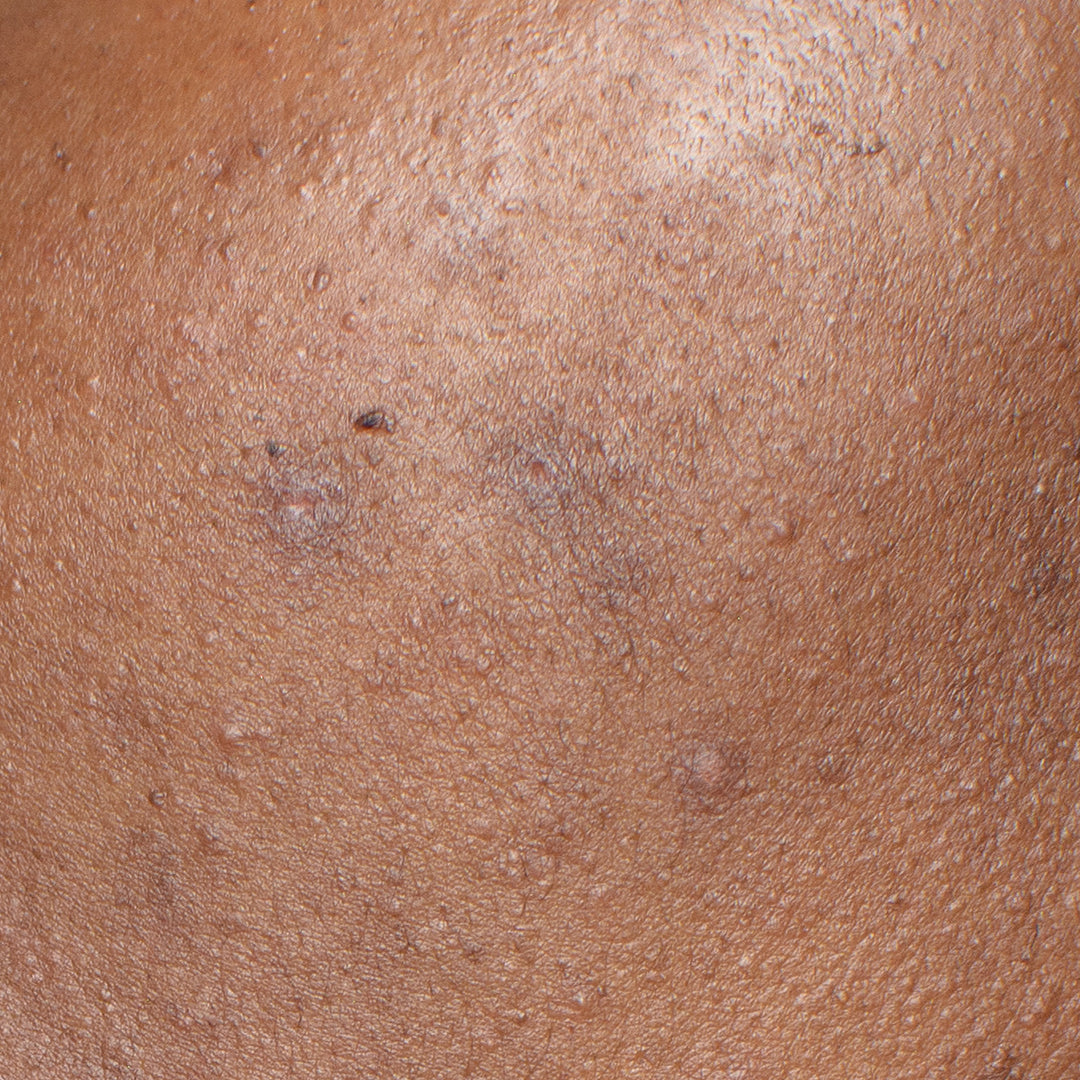 tamanu oil for dark spots