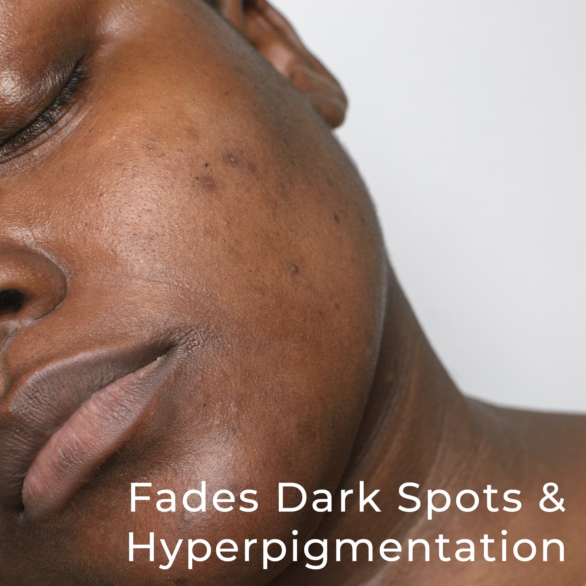 New Turmeric Face Mask Fades Dark Spots and Hyperpigmentation